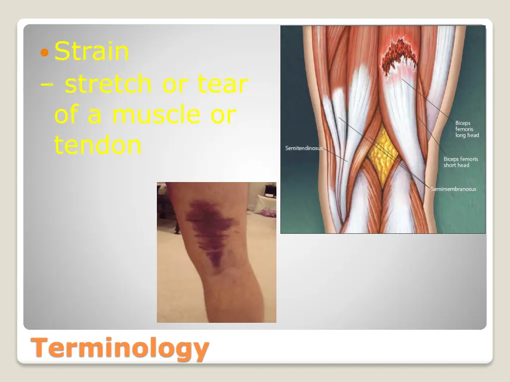 strain stretch or tear of a muscle or tendon