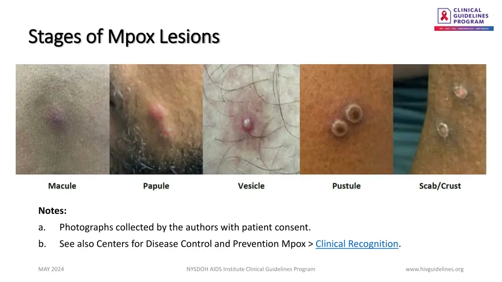 stages of stages of mpox