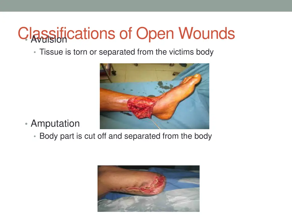 classifications of open wounds avulsion tissue