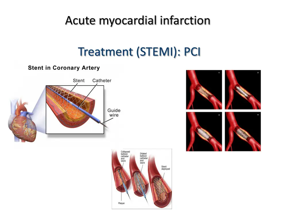 acute myocardial infarction