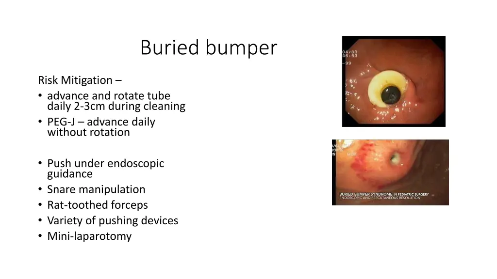 buried bumper