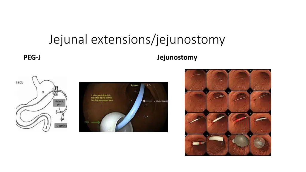 jejunal extensions jejunostomy