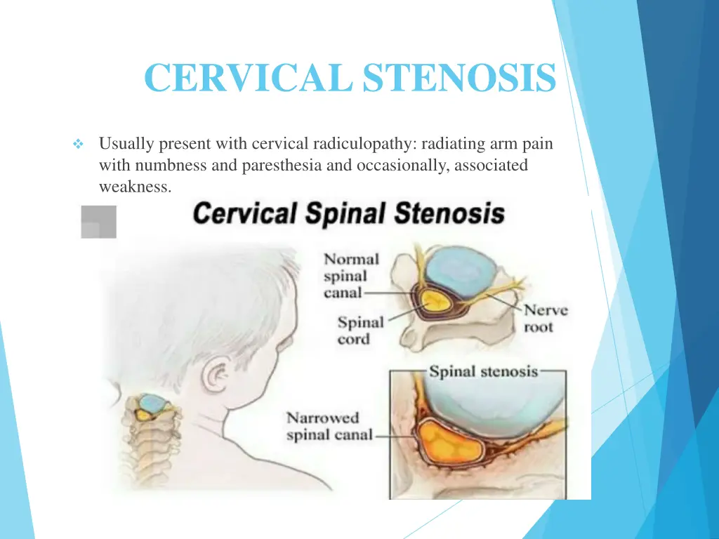 cervical stenosis