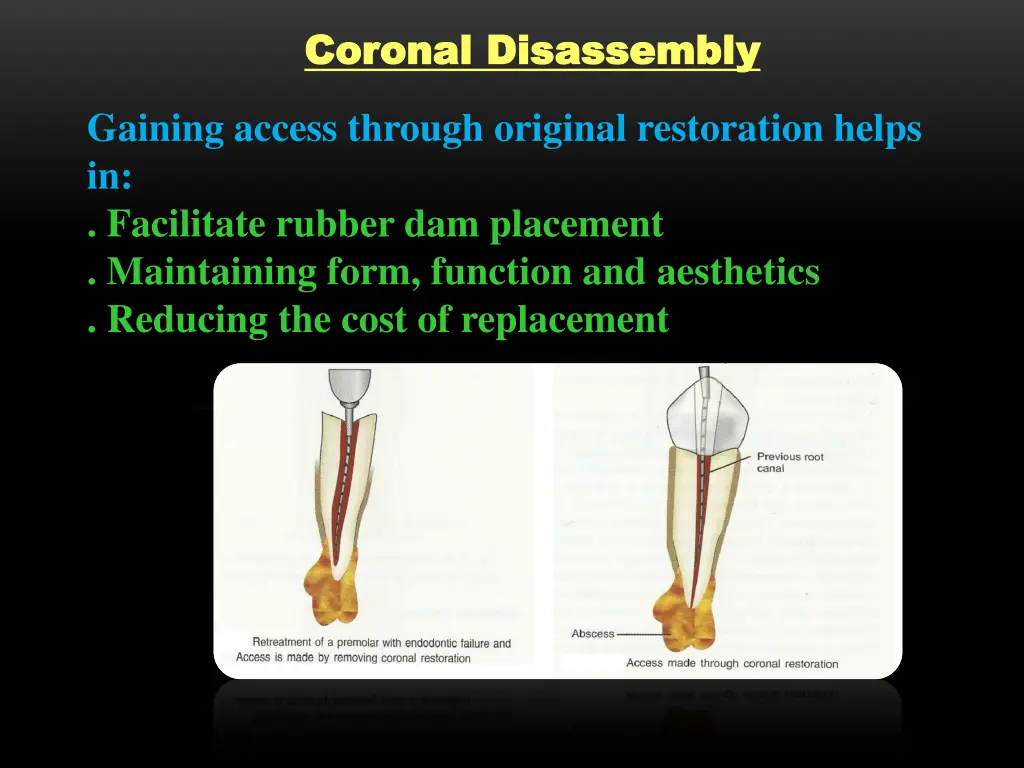 coronal disassembly coronal disassembly 1