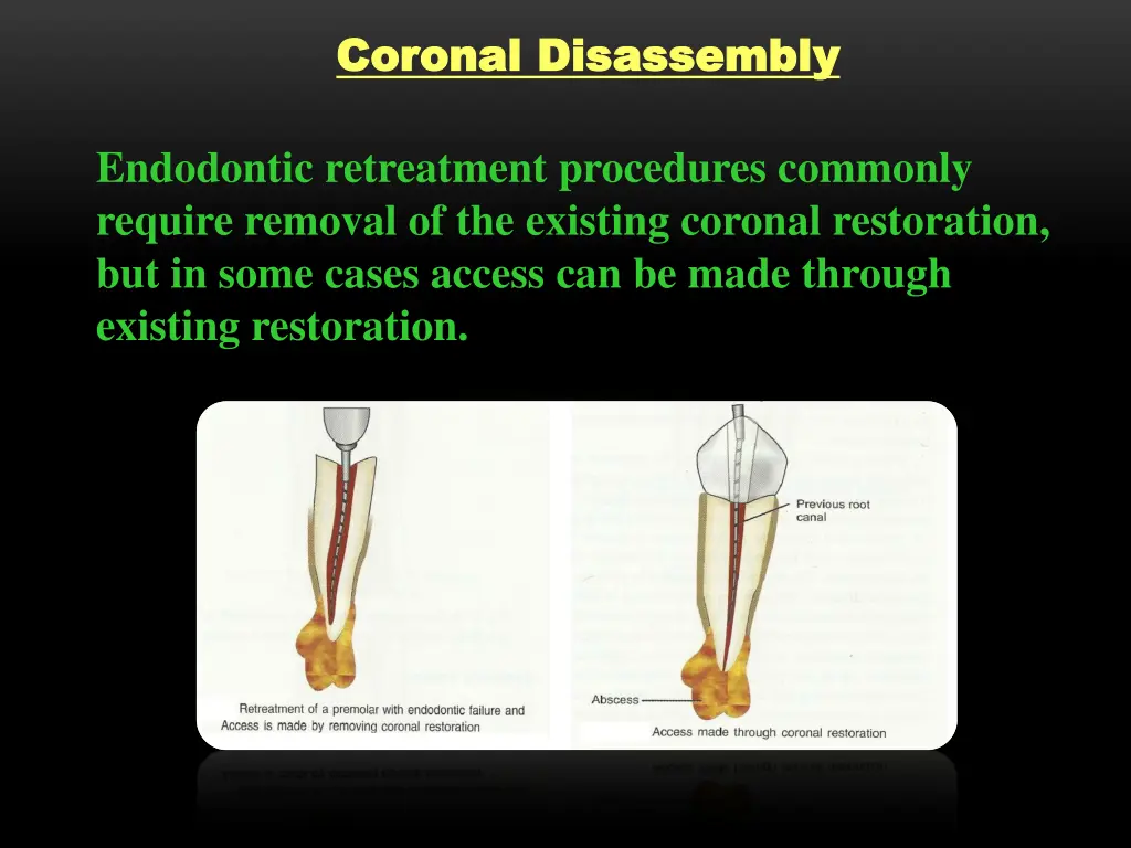 coronal disassembly coronal disassembly