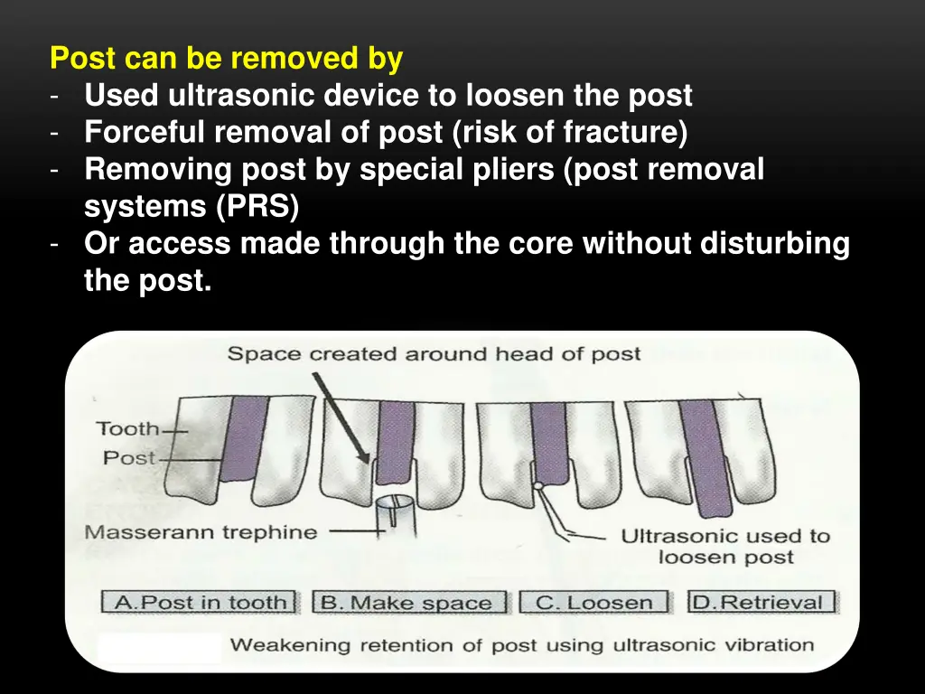 post can be removed by used ultrasonic device