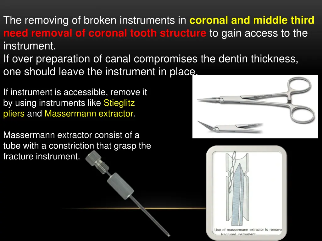 the removing of broken instruments in coronal