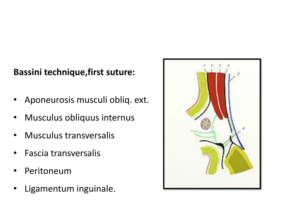 bassini technique first suture aponeurosis