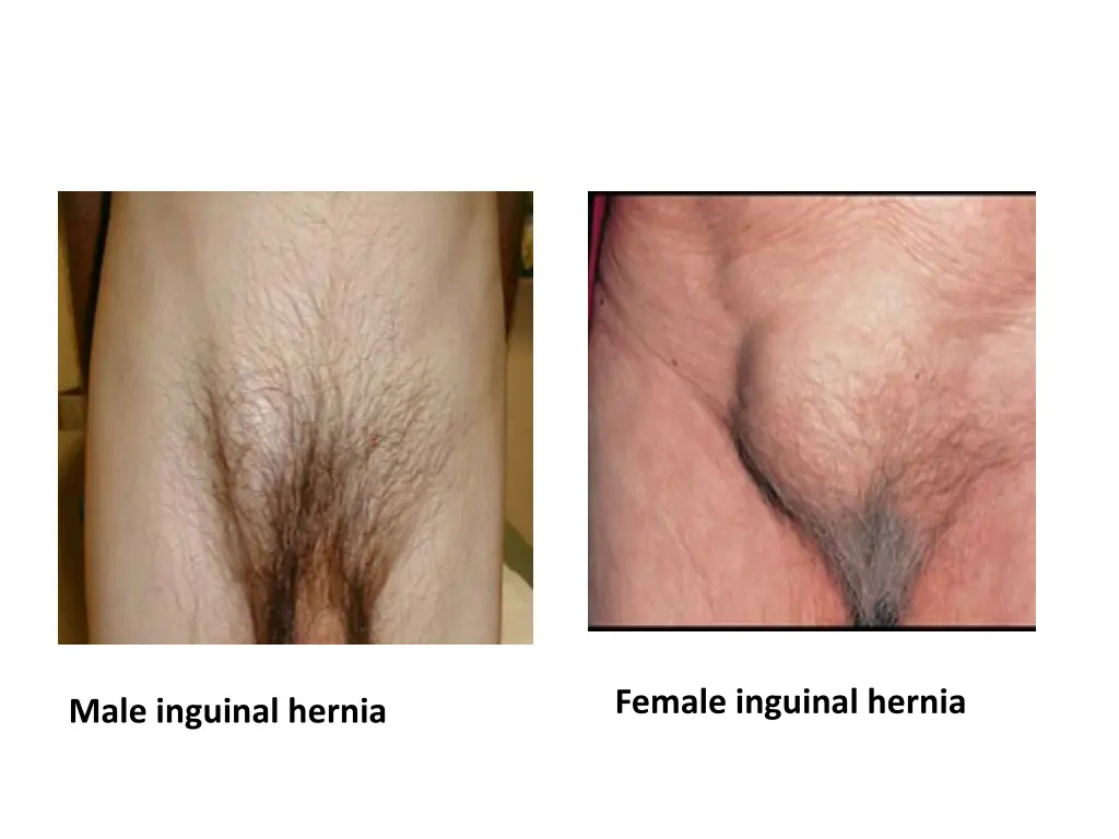 female inguinal hernia