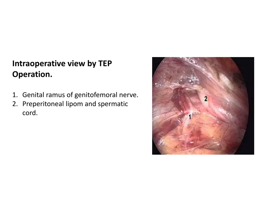 intraoperative view by tep operation