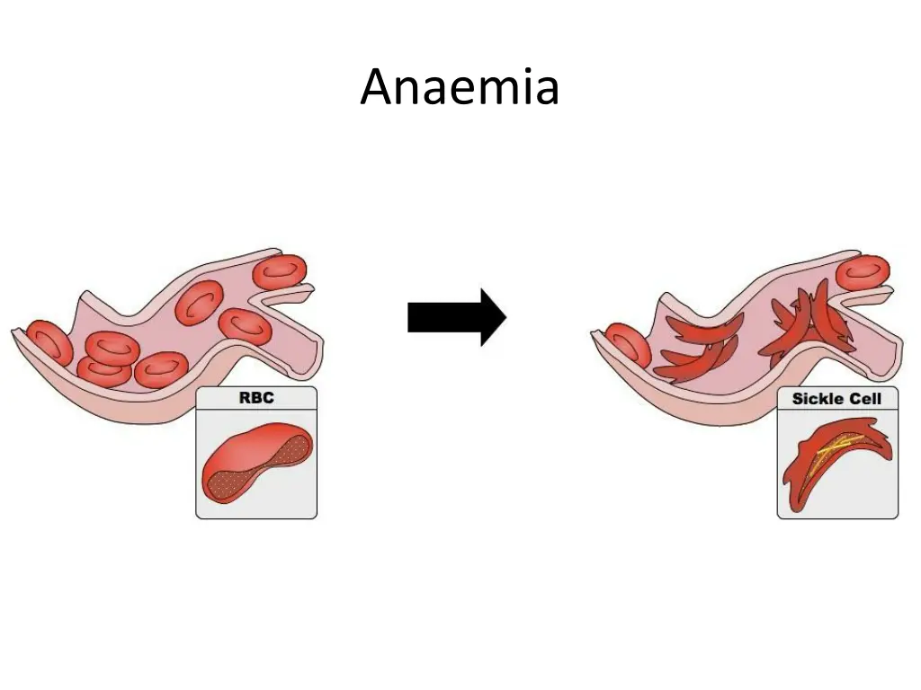 anaemia