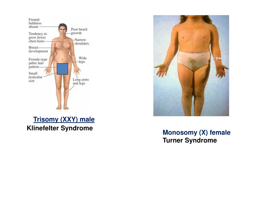 trisomy xxy male