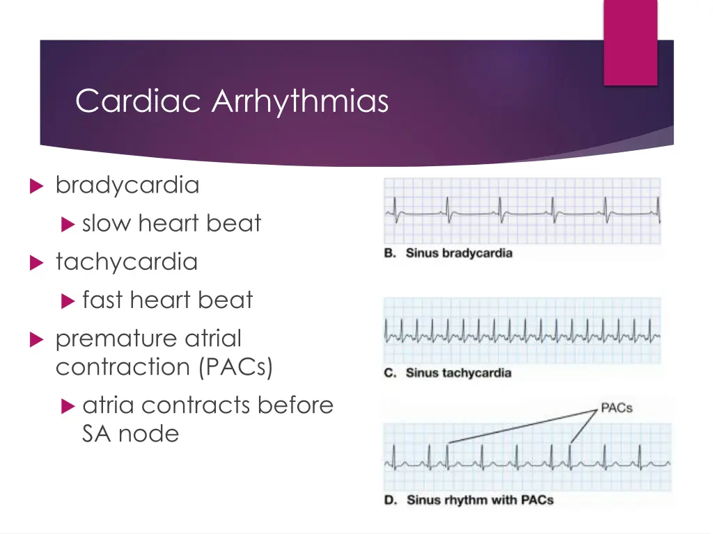 cardiac arrhythmias 1