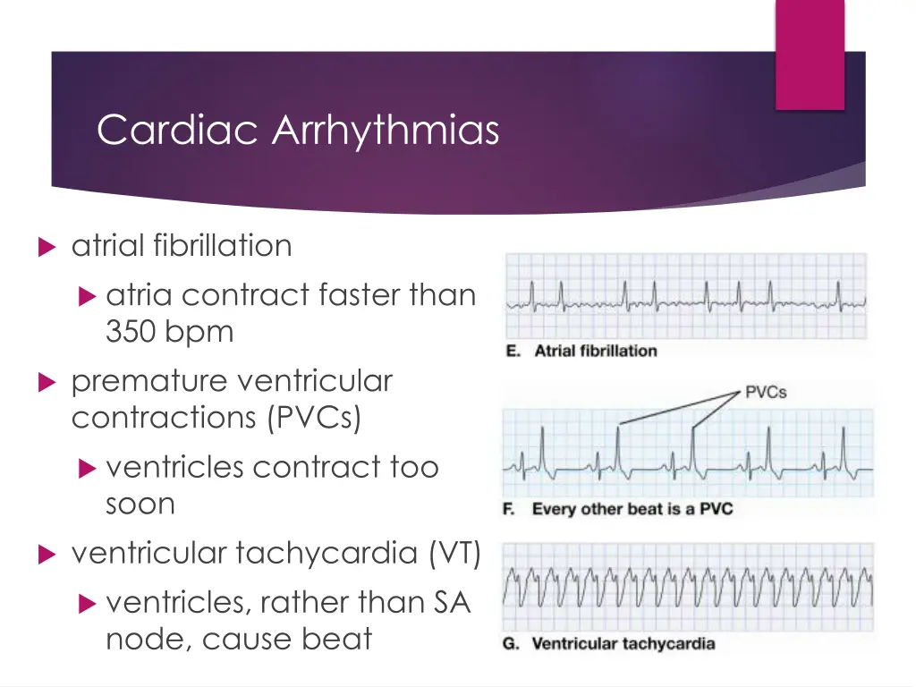 cardiac arrhythmias 2