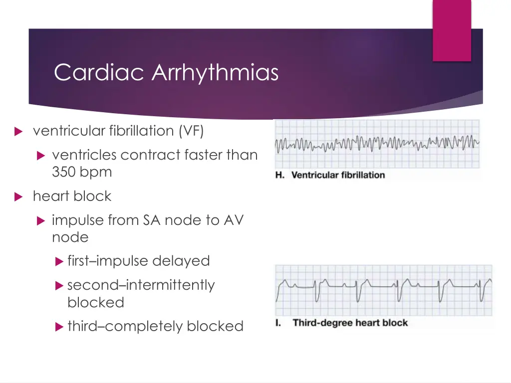 cardiac arrhythmias 3