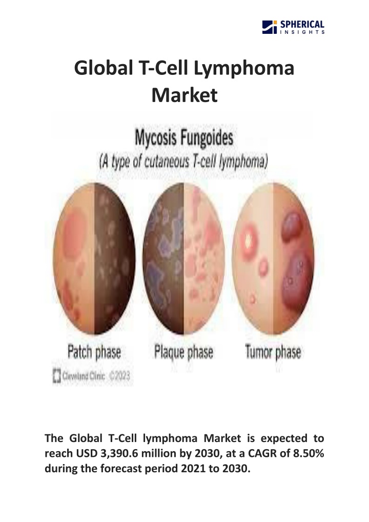 global t cell lymphoma market