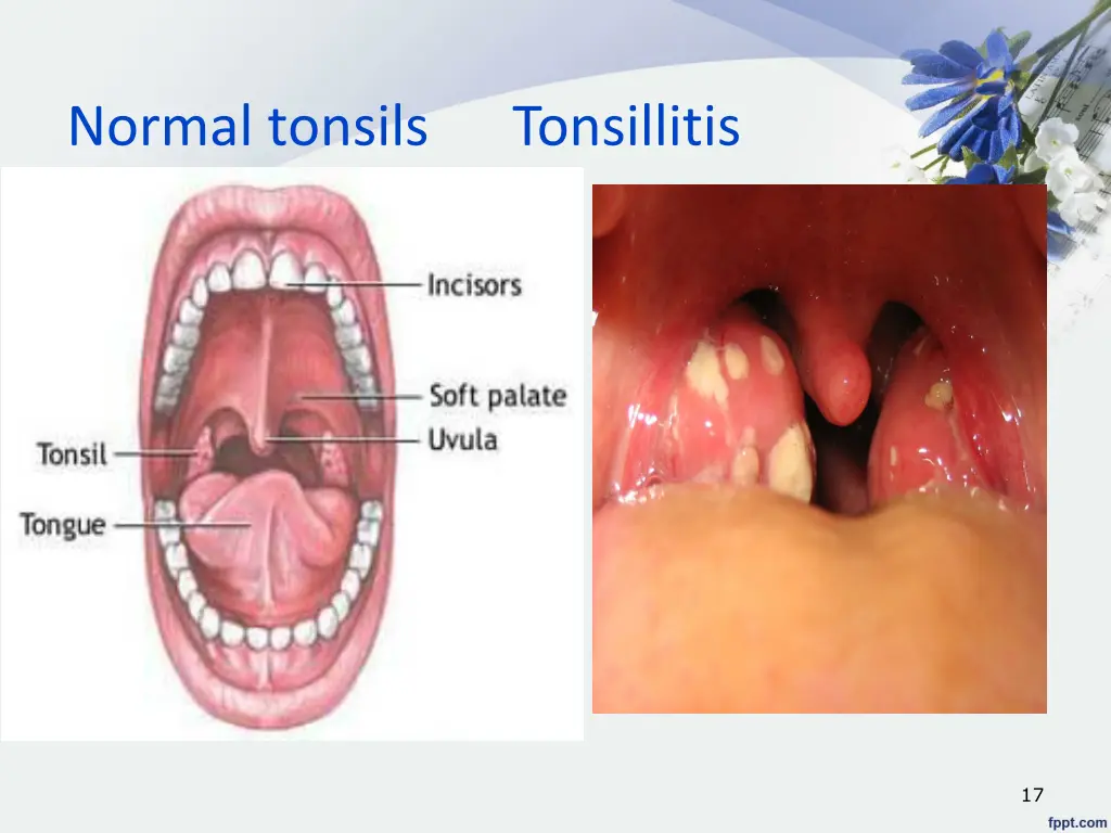 normal tonsils tonsillitis