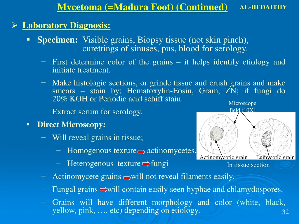 mycetoma madura foot continued 1