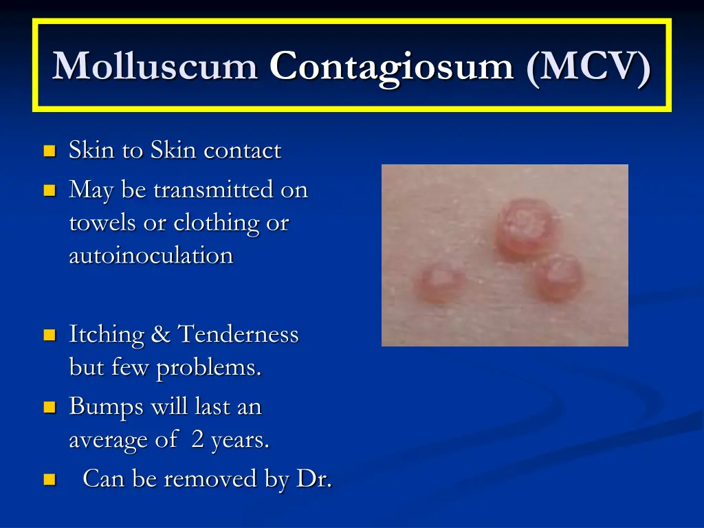 molluscum contagiosum mcv