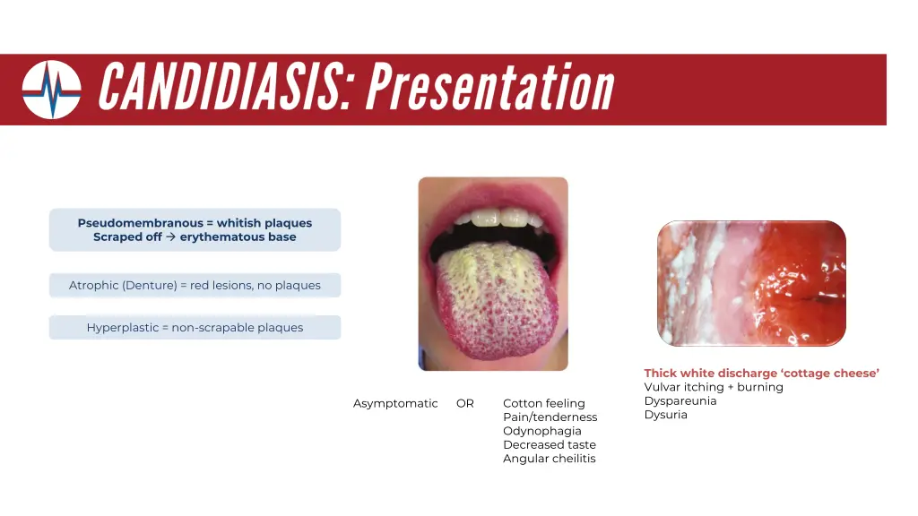 pseudomembranous whitish plaques scraped