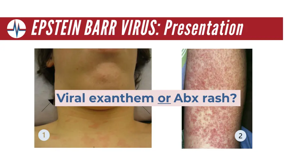 viral exanthem or abx rash