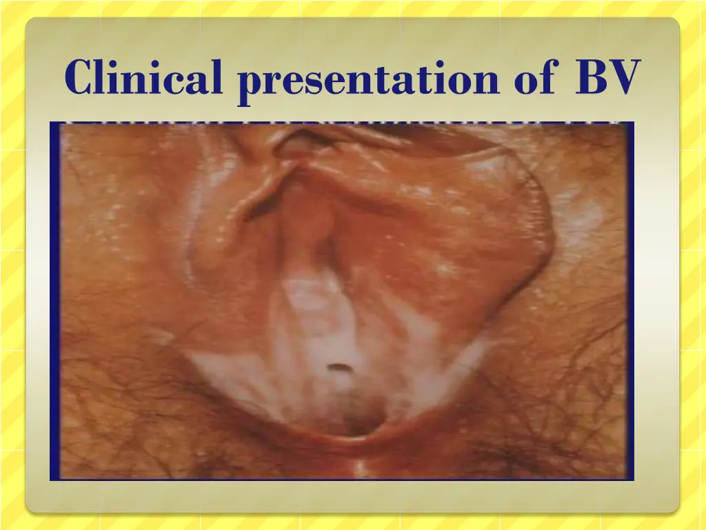 clinical presentation of bv