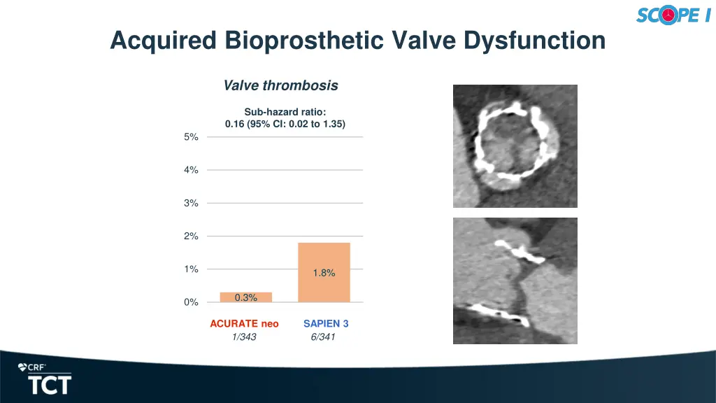 acquired bioprosthetic valve dysfunction 1