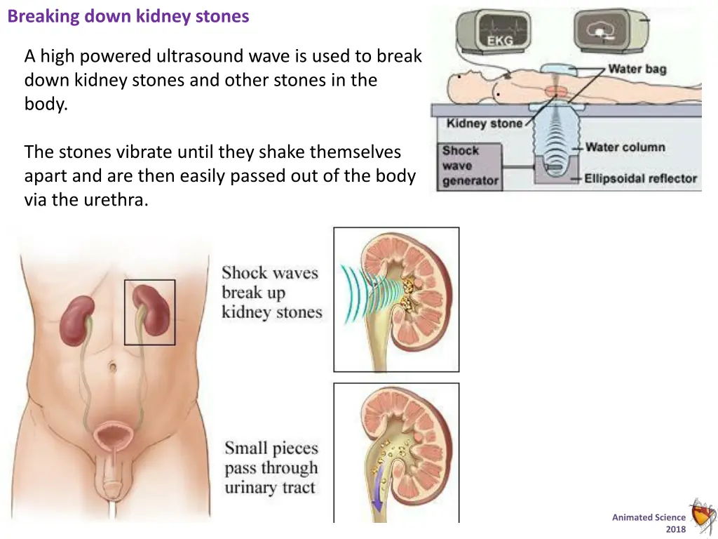 breaking down kidney stones