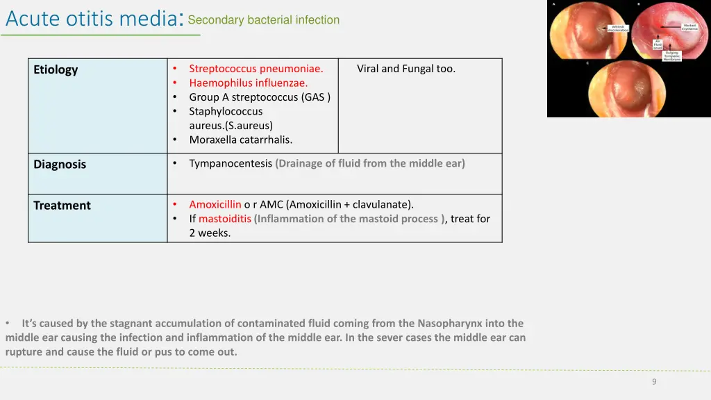 acute otitis media