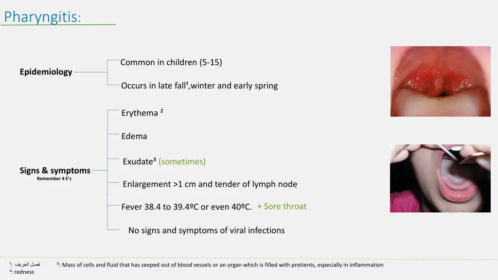 pharyngitis