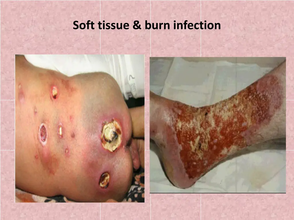 soft tissue burn infection