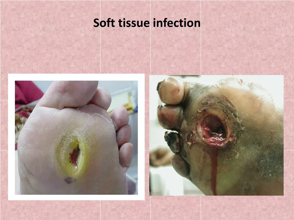 soft tissue infection