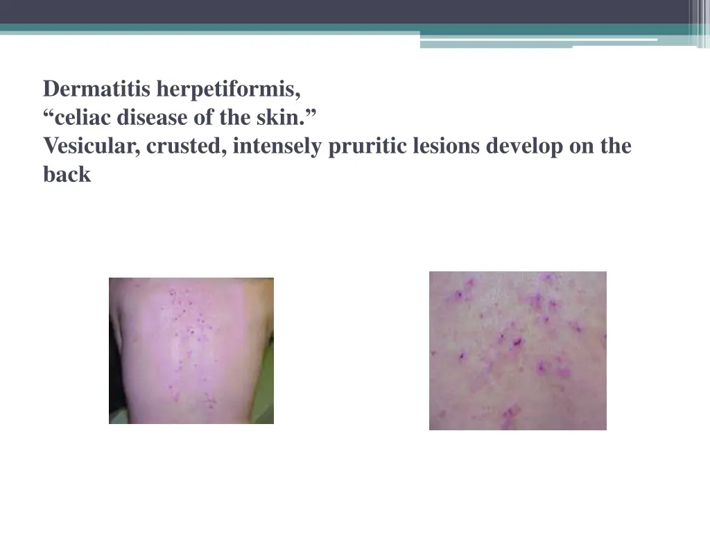 dermatitis herpetiformis celiac disease