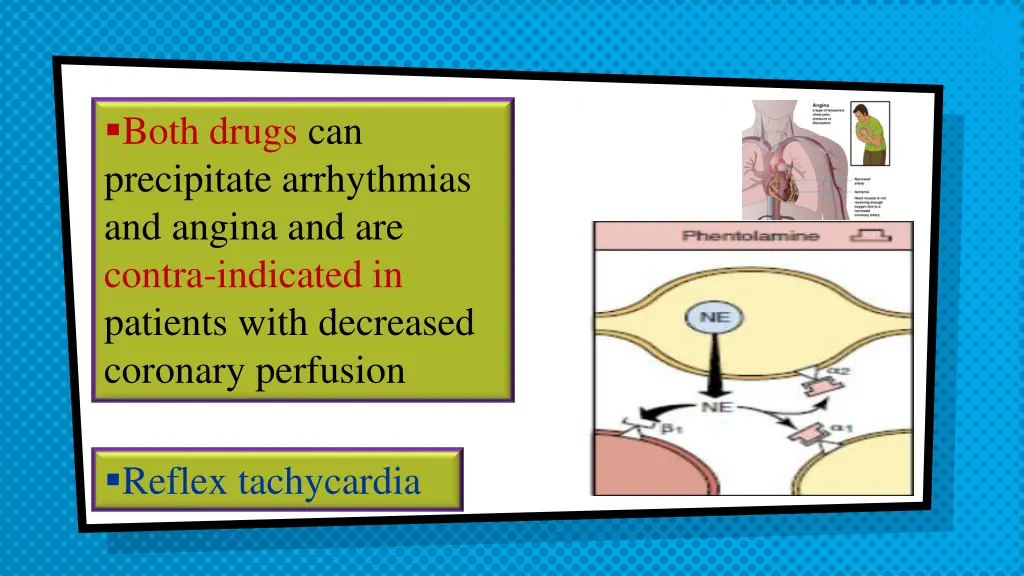 angina arrhythmia