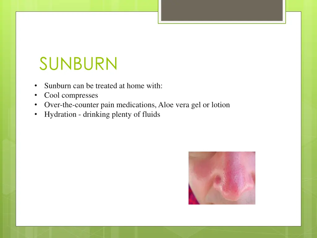 sunburn