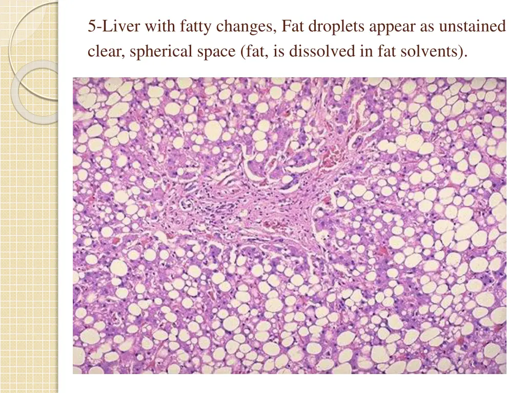 5 liver with fatty changes fat droplets appear