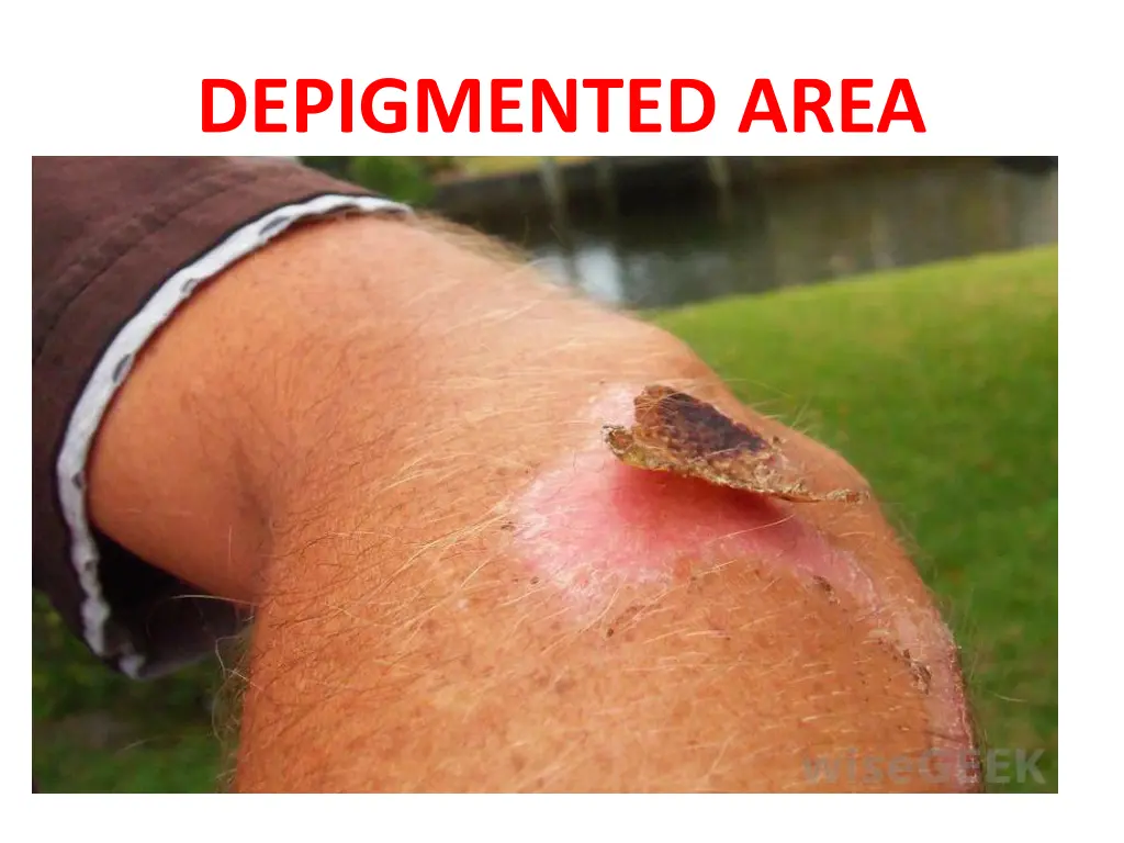 depigmented area