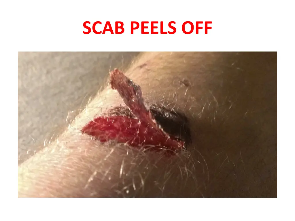 scab peels off