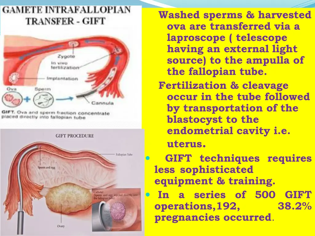 washed sperms harvested ova are transferred