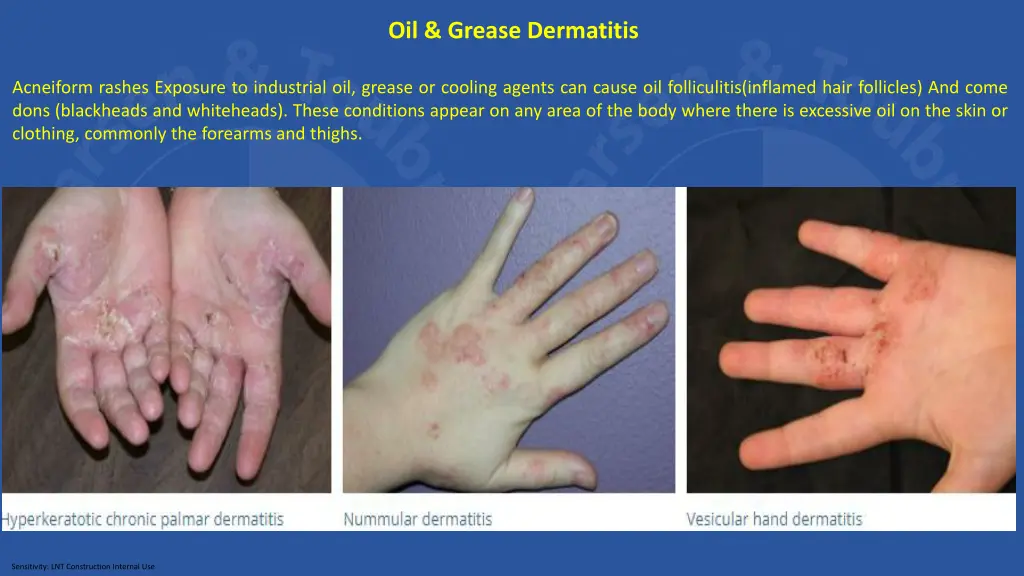 oil grease dermatitis