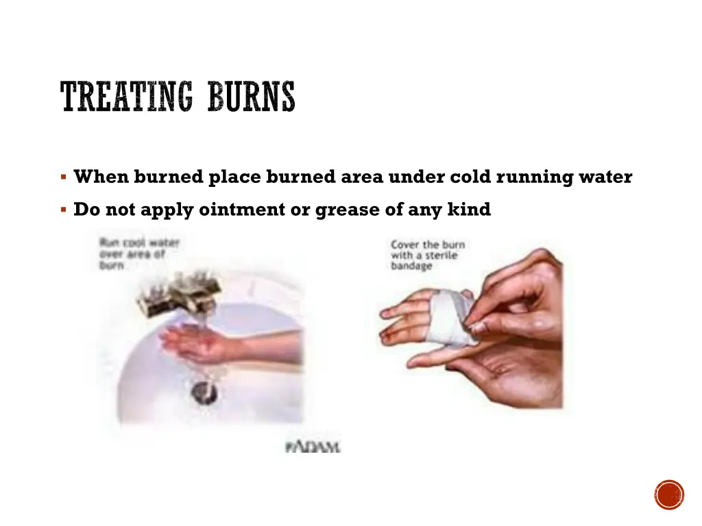 treating burns