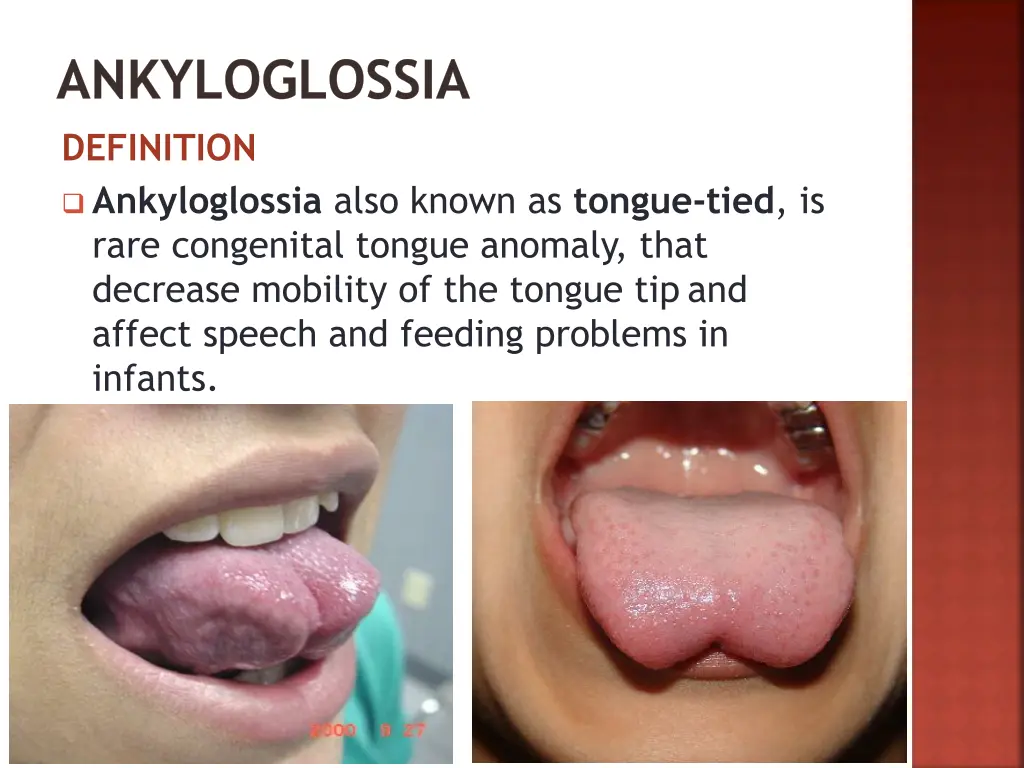 ankyloglossia definition ankyloglossia also known