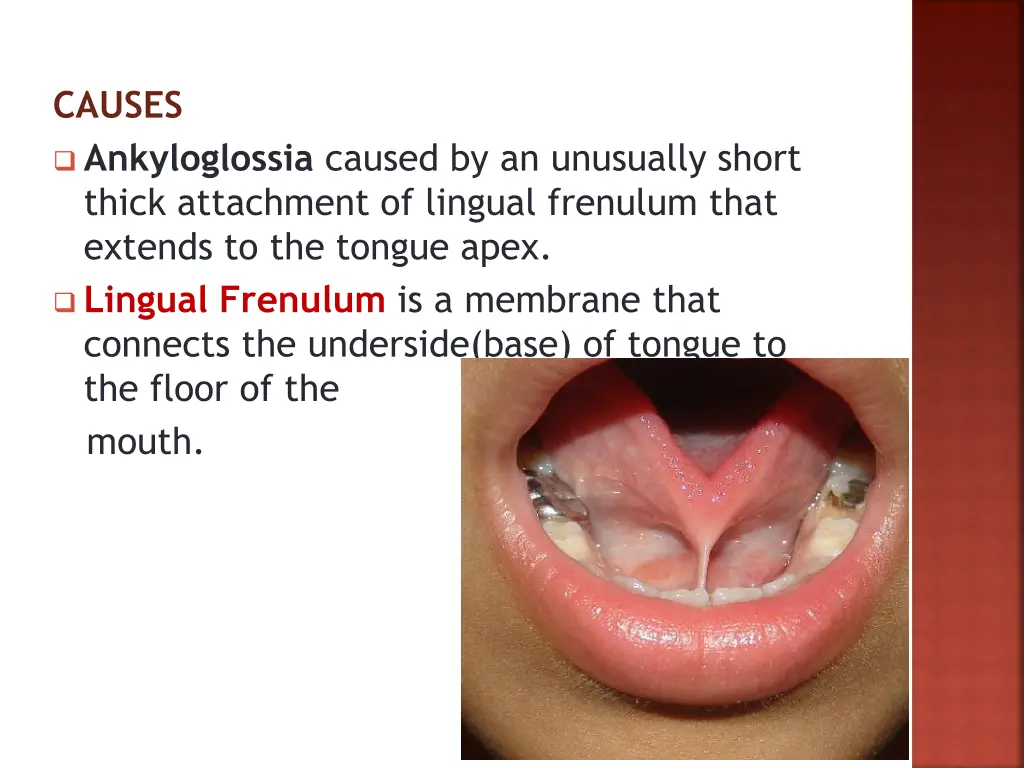 causes ankyloglossia caused by an unusually short