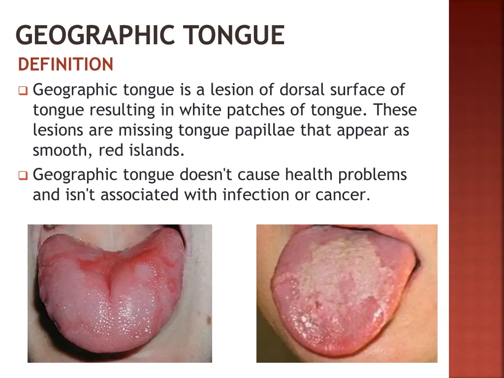 geographic tongue definition geographic tongue