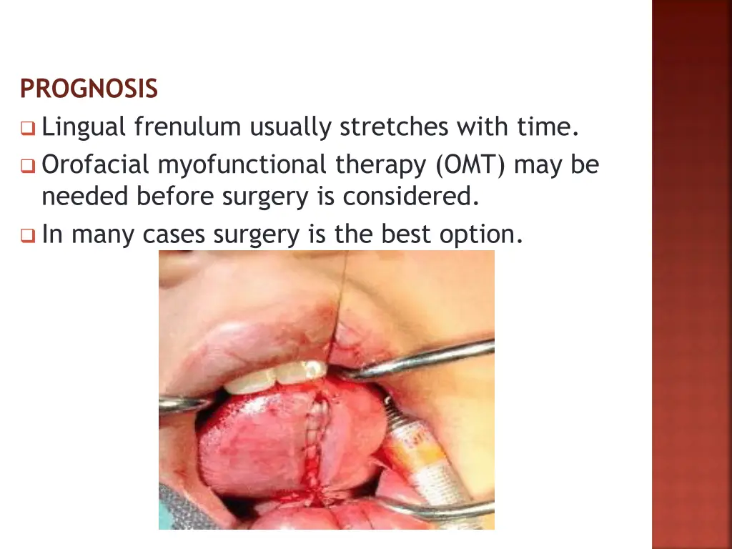 prognosis lingual frenulum usually stretches with