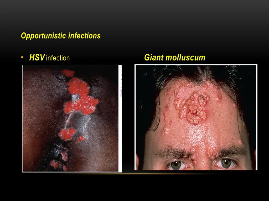 opportunistic infections