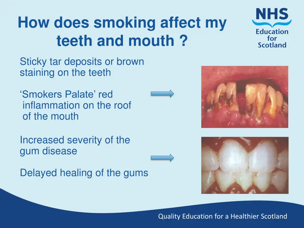 how does smoking affect my teeth and mouth