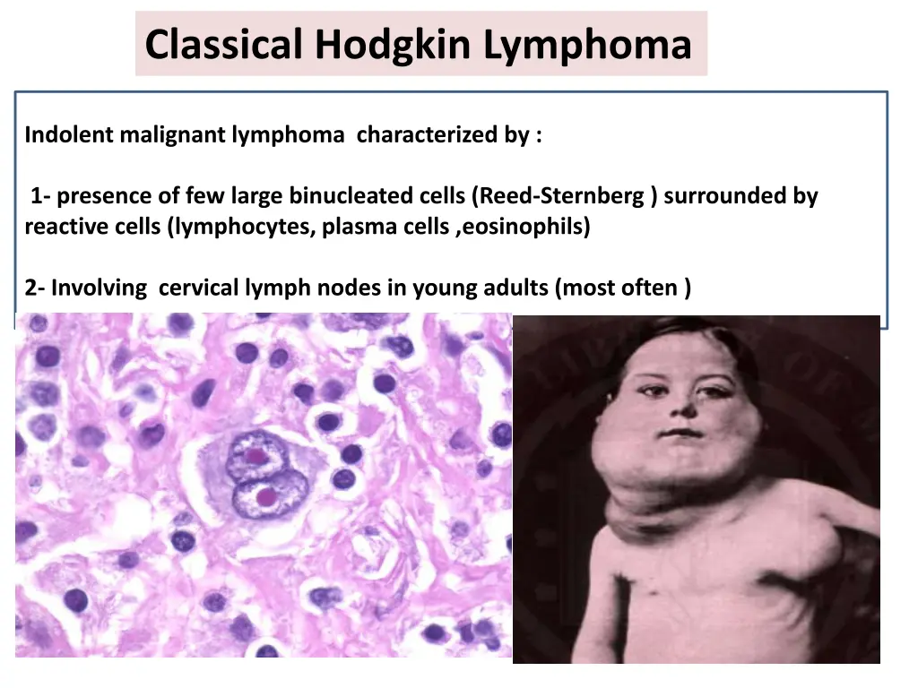 classical hodgkin lymphoma