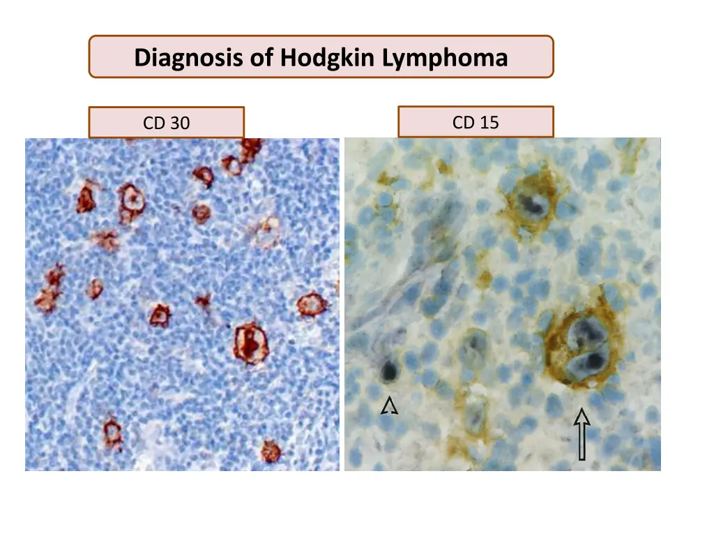 diagnosis of hodgkin lymphoma