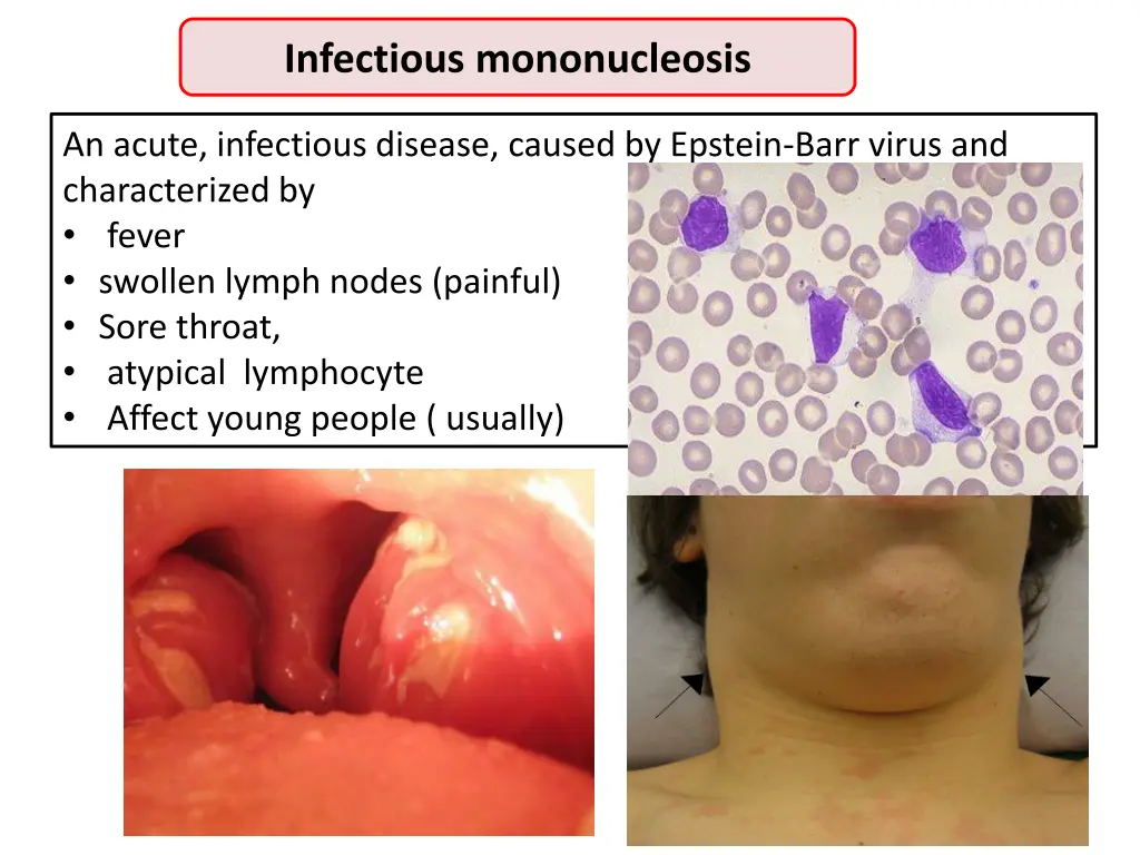 infectious mononucleosis